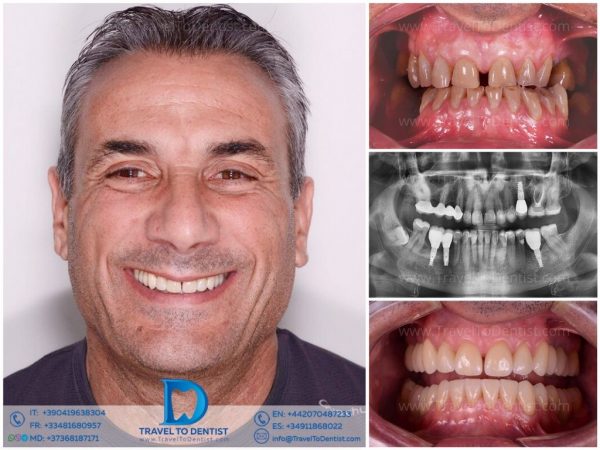 Resultado de tratamiento dental caso clínico 2