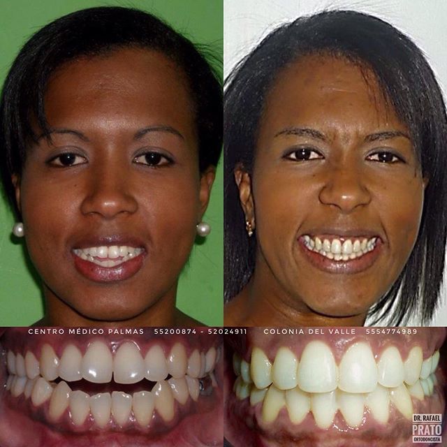 Resultado de tratamiento dental caso clínico 4